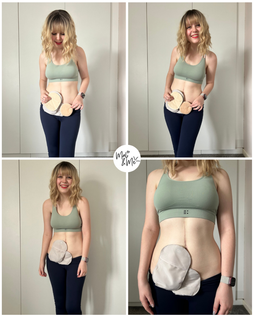 Woman in four different images showing her stoma bags and mucus fistula